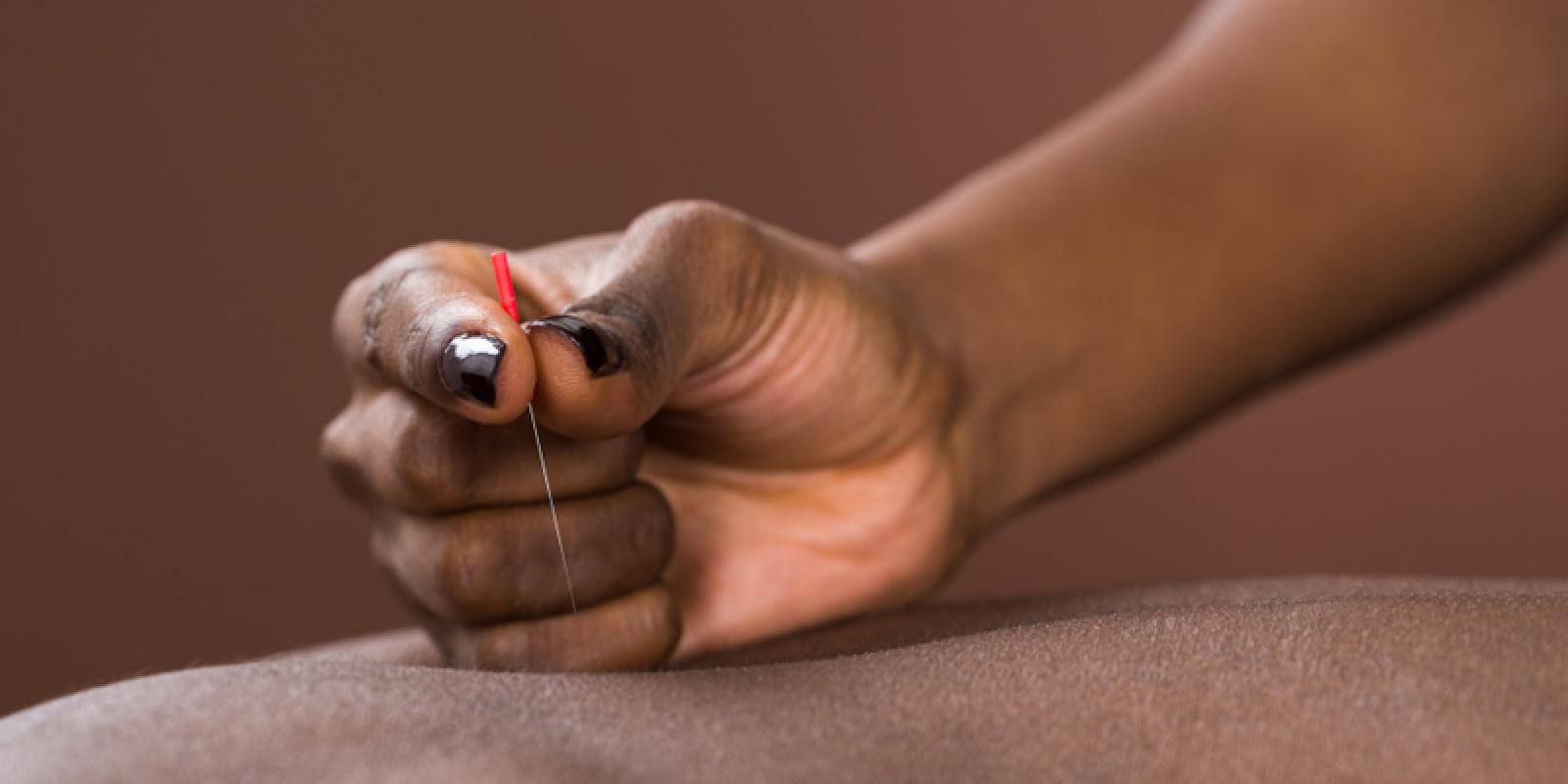 Man getting acupuncture treatment